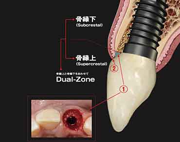 Dual-Zone
