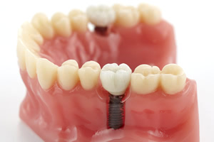 歯周病がインプラントに与える影響