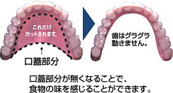 従来入れ歯とは大きさ・形が違う