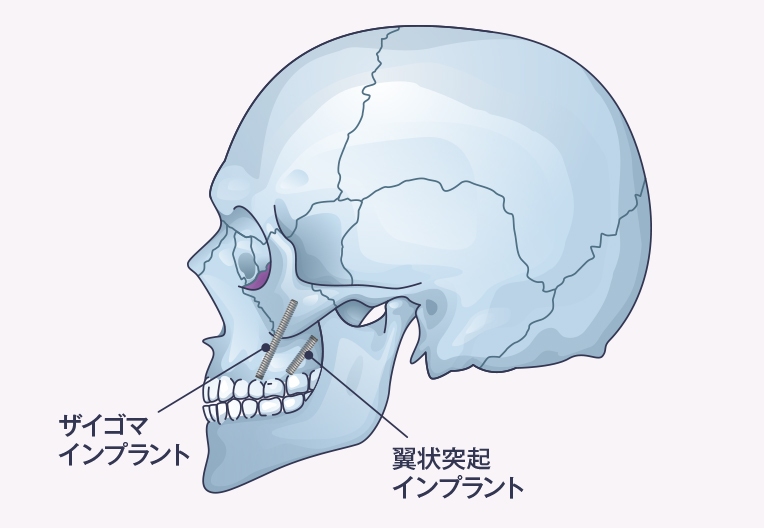 プテリゴイドインプラントとザイゴマインプラントの比較