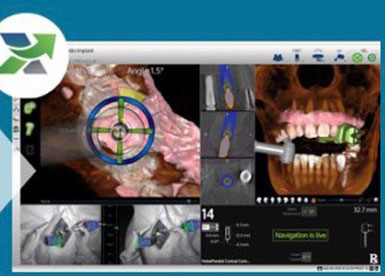 インプラント手術ナビゲーションシステムX-ガイド | 五十嵐歯科医院
