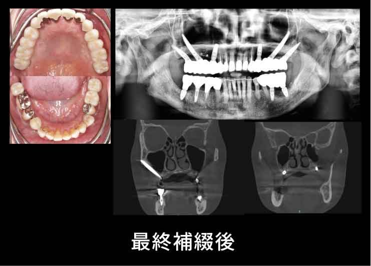 脂肪組織をインプラント表面に挿入