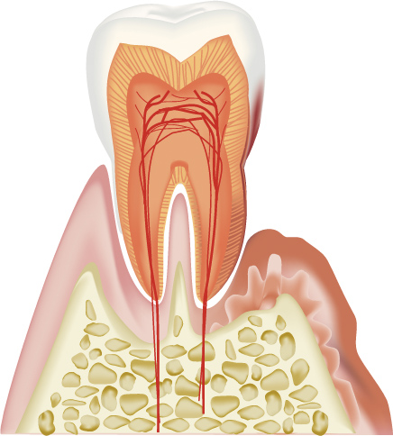 歯周病の原因