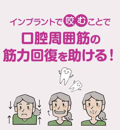 インプラントで咬むことで口腔周囲筋の筋力回復を助ける！