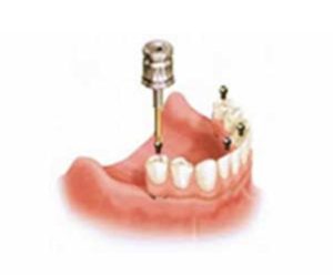 allon4_overdenture_01